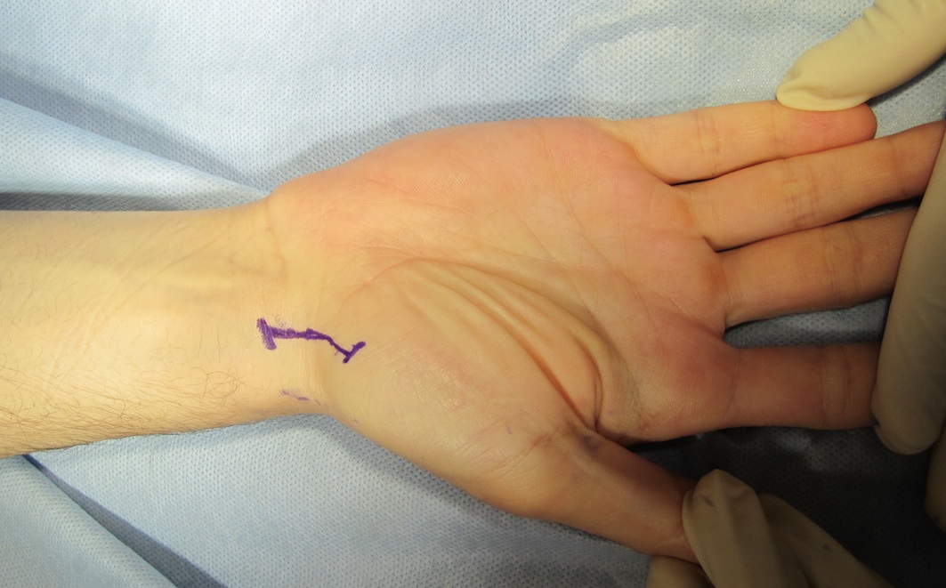 Scaphoid Approach